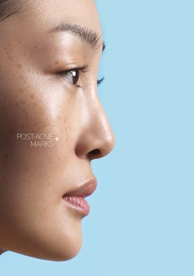 /-/media/project/loreal/brand-sites/lrp/emea/tsh/products/effaclar/effaclar-a-z-gel-cream/desktop/lrp-effaclar_azcream_flip_card_front_desktop_3.jpg