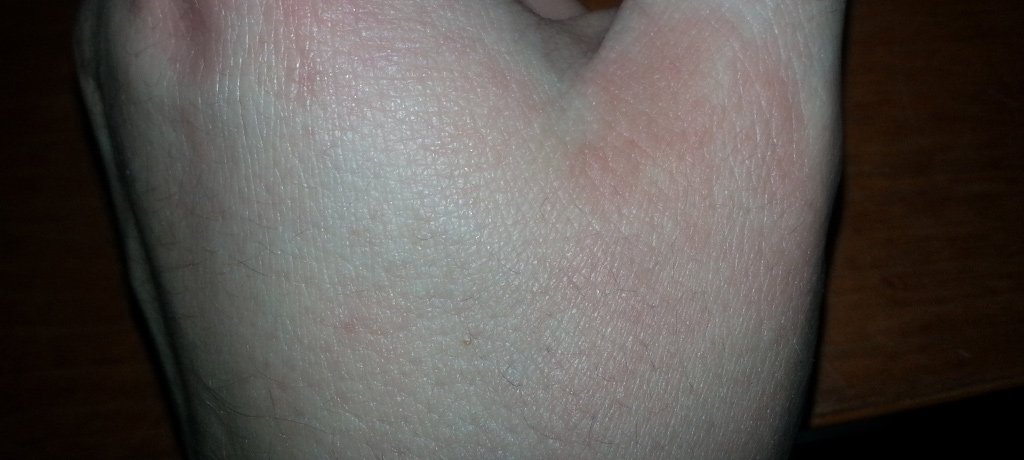 lrp-before-after-hand-1