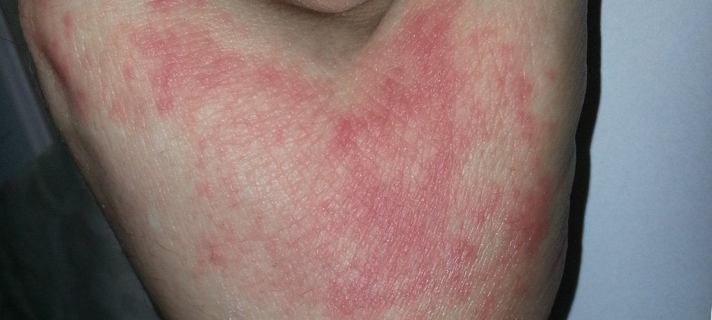 lrp-before-after-hand-2